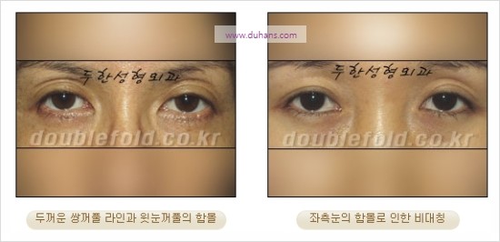 [두한성형외과 경쟁력 눈성형] - [눈꺼풀이 꺼진 경우의 쌍꺼풀 라인을 교정하기 위한 미세지방이식] 관련 이미지 2