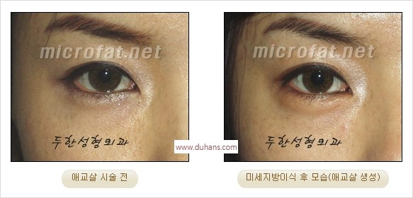 [두한성형외과 경쟁력 미세지방이식] - [애교살 필러 시술의 부작용 교정] 관련 이미지 16