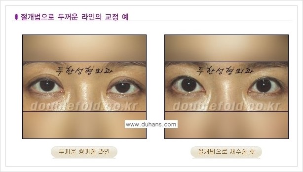 [두한성형외과 경쟁력 쌍꺼풀 재수술] - [두껍고 어색한 라인 교정하는 방법 안내 2.] 관련 이미지 4