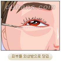 [두한성형외과 안검성형] - [상안검, 하안검] 관련 이미지 19