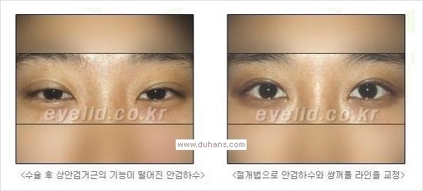 [두한성형외과 경쟁력 눈성형] - [안검하수(졸리운 눈매)의 종류와 교정 방법 안내] 관련 이미지 16