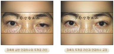 [Duhan Plastic Surgery Eye Surgery] - [Asymmetric Line, Eyelash Eversion, Deep Fixation] image 9