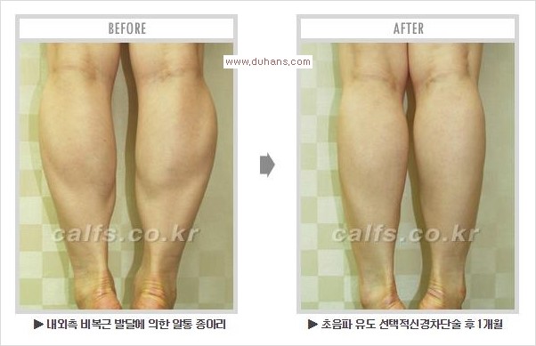 [두한성형외과 경쟁력 멀티종아리성형] - [알통종아리 해결 - 비절개 초음파 선택적 신경차단술] 관련 이미지 15