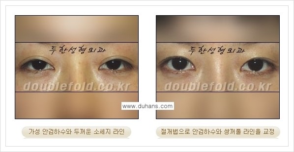 [두한성형외과 경쟁력 쌍꺼풀 재수술, 극한 눈 재수술] - [안검하수(졸리운 눈매) 재수술 안내] 관련 이미지 3