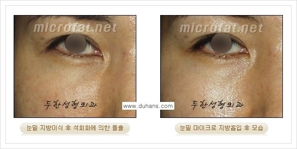[두한성형외과 겨울엔 지방흡입을] - [볼살, 눈밑, 턱선의 초음파 미세지방흡입 2.] 관련 이미지 2