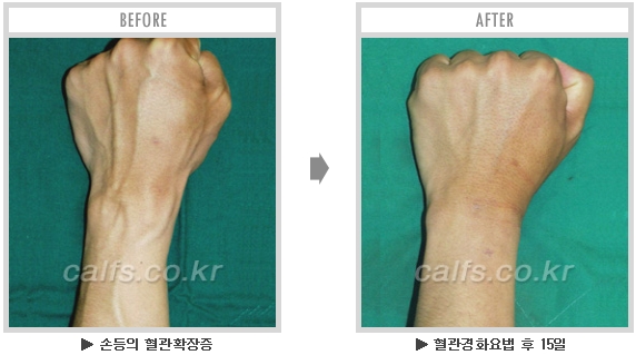 [종아리성형 두한성형외과] - [종아리수술에 대한 자주하는 질문과 답변 모음] 관련 이미지 37