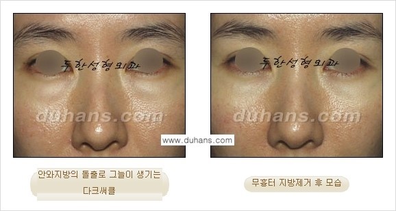 [두한성형외과 경쟁력 지방제거, 지방재배치] - [상큼하고 젊은 눈매 만들기 안내] 관련 이미지 25
