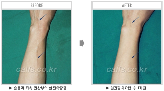 [종아리성형 두한성형외과] - [종아리수술에 대한 자주하는 질문과 답변 모음] 관련 이미지 43