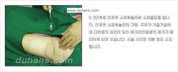 [두한성형외과 성형 FOCUS 지방흡입] - [액취증 - 다한증 초음파 컷터 지방흡입 ④] 관련 이미지 7