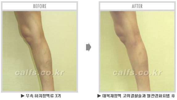 [종아리성형 두한성형외과] - [종아리수술에 대한 자주하는 질문과 답변 모음] 관련 이미지 23