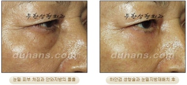 Blepharoplasty, Duhan Plastic Surgery - Upper and Lower Eyelids image 33