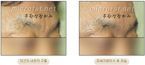 [두한성형외과 자가지방이식] - [미간주름] 관련 이미지 18