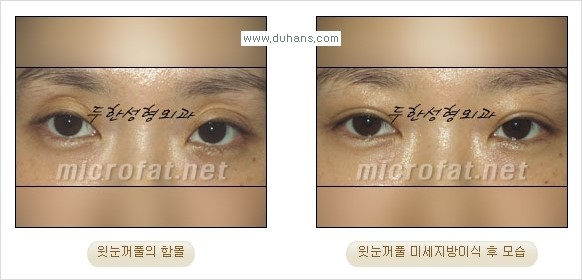 [두한성형외과 경쟁력 미세 #지방이식 ] - [윗 #눈꺼풀함몰, #꺼진눈꺼풀, #눈위지방이식, #눈위함몰] 관련 이미지 19