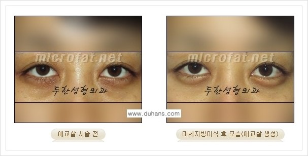 [두한성형외과 경쟁력 눈밑성형] - [애교살과 다크써클과의 관계] 관련 이미지 18