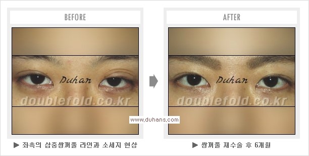 [두한성형외과 경쟁력 쌍꺼풀 재수술, 극한 눈재수술] - [쌍꺼풀 재수술을 위한 검사와 테스트] 관련 이미지 11
