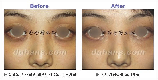 [두한성형외과 경쟁력 동안성형 리더] - ​[미간주름, 이마주름, 안검성형, 이마거상술, 눈썹거상술] 관련 이미지 119