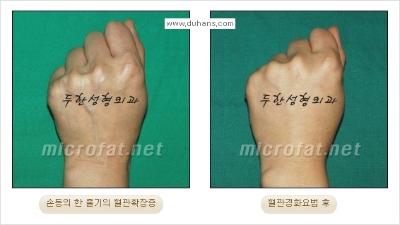 [두한성형외과 경쟁력 정맥류 치료] - [손, 손등, 손목혈관확장증, 팔혈관확장증에 질문과 답변] 관련 이미지 11