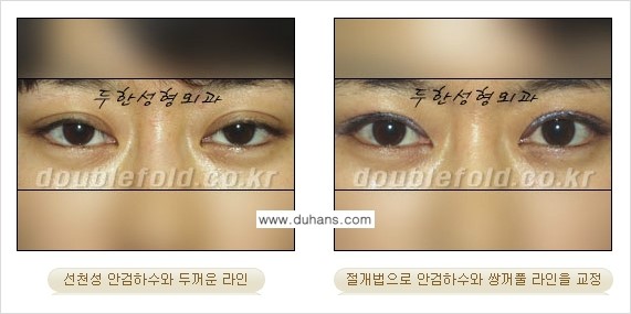 [두한성형외과 경쟁력 눈성형] - [안검하수 수술 방법] 관련 이미지 10