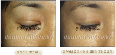 [두한성형외과 쌍커풀재수술] - [심한 소세지눈, 두줄따기, 쌍꺼풀 흉터] 관련 이미지 43