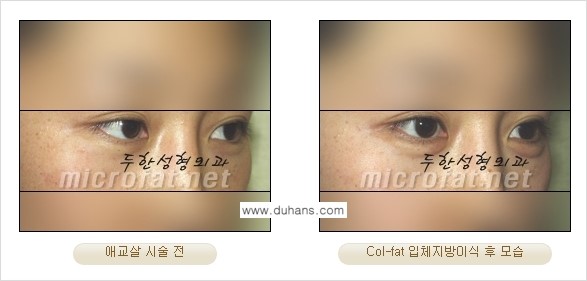 [두한성형외과 경쟁력 미세지방이식] - [Col-fat(콜펫) 지방이식의 특징과 차이점 안내] 관련 이미지 7