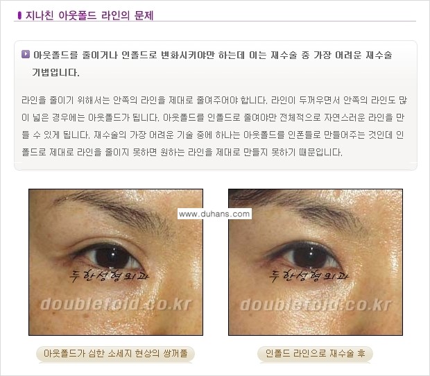 [두한성형외과 극한 재수술, 쌍꺼풀 재수술] - [쌍꺼풀 재수술에서 극복해야 할 극한의 상황과 문제] 관련 이미지 5