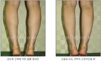 ​[두한성형외과 종아리수술] - [나에게 맞는 종아리성형방법] 관련 이미지 17