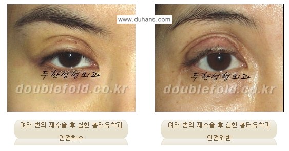 [두한성형외과 신두한 원장 눈성형 관련 컬럼] - [극한 눈재수술] 관련 이미지 1