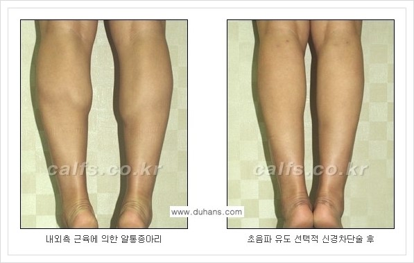 [두한성형외과의 경쟁력 멀티 종아리성형] - [근육퇴축을 위한 초음파 유도 선택적 신경차단술 안내] 관련 이미지 9