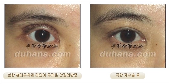 [두한성형외과 경쟁력 쌍꺼풀 재수술 리더 ] - [쌍꺼풀 재수술 과정, 쌍꺼풀 재수술 실패의 원인, 극한 재수술] 관련 이미지 12