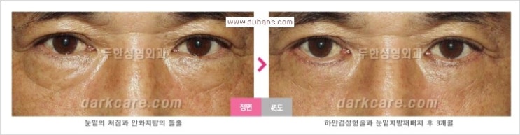 [두한성형외과 경쟁력 눈밑성형] - [Dr. 컬럼 "눈밑 지방재배치의 문제점"] 관련 이미지 5