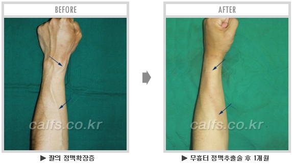 [종아리성형 두한성형외과] - [종아리수술에 대한 자주하는 질문과 답변 모음] 관련 이미지 35