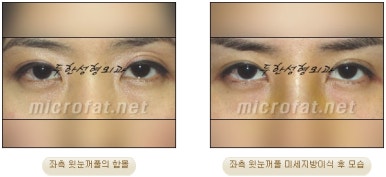 [Doohan Plastic Surgery Autologous Fat Grafting] - [Sunken Eye Fat Grafting] image 32