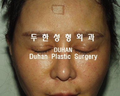 [Duhan Plastic Surgery Double Eyelid Revision] - [Reducing the Double Eyelid Line] image 23