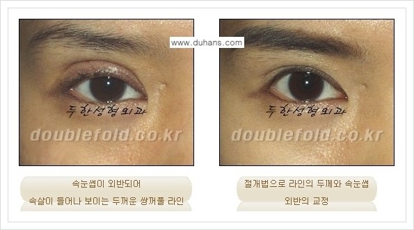 [두한성형외과 경쟁력 쌍꺼풀 재수술, 극한 재수술] - [망가진 눈 복원수술 - 속눈썹 외반 교정 안내] 관련 이미지 5