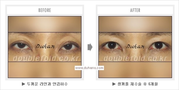 [두한성형외과 경쟁력 쌍꺼풀 재수술, 극한 눈재수술] - [과교정 된 눈매교정] 관련 이미지 6