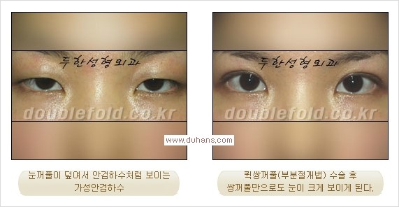 [두한성형외과 경쟁력 눈성형] - [안검하수(졸린눈매) 눈매교정 여러 가지 방법 안내] 관련 이미지 14
