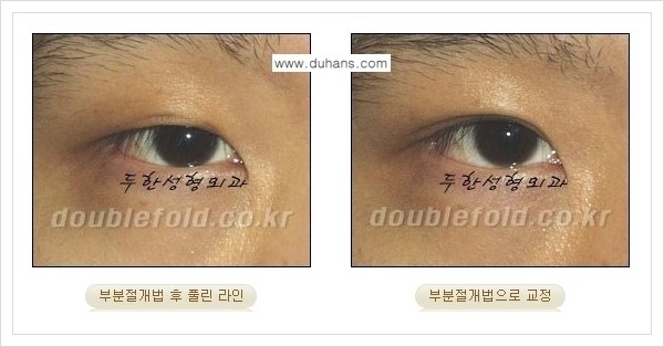 [두한성형외과 경쟁력 쌍꺼풀 재수술(극한 재수술)] - [라인이 풀렸을 경우의 쌍꺼풀 재수술 안내 ②] 관련 이미지 4