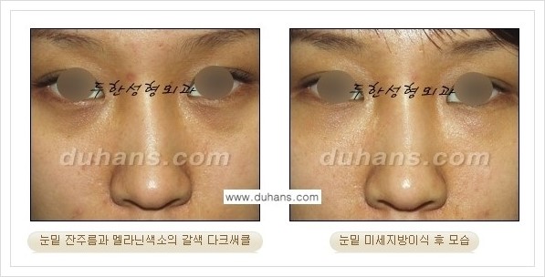 [두한성형외과 경쟁력 눈밑성형] - [꺼진 눈밑, 눈밑 함몰 주름선 눈밑 미세지방이식 안내] 관련 이미지 25
