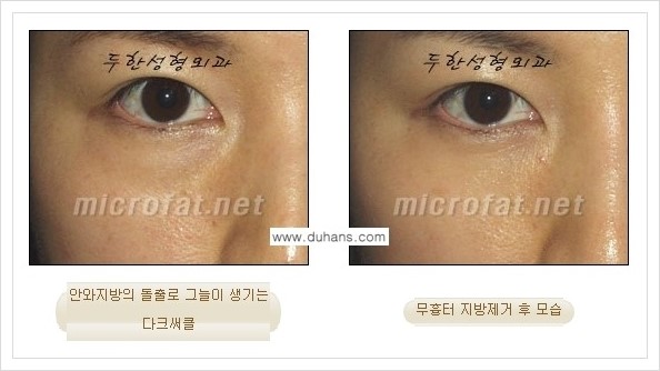[두한성형외과 경쟁력 눈밑성형] - [눈밑지방제거, 눈위지방제거 안내 2.] 관련 이미지 14