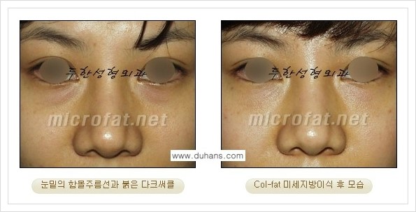 [두한성형외과 경쟁력 눈밑성형] - [눈밑 다크써클, 눈밑 주름의 교정 안내 2.] 관련 이미지 15
