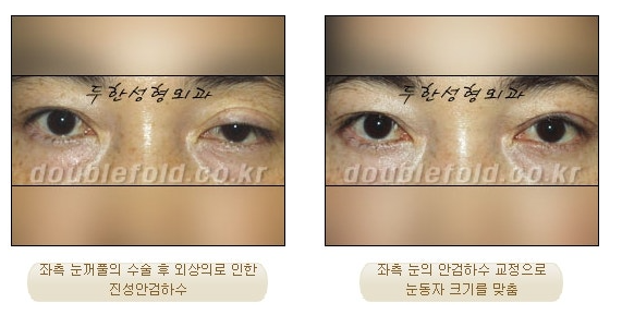 과교정 눈매 (소세지 쌍커풀 재수술, 눈매교정 재수술) 관련 이미지 8