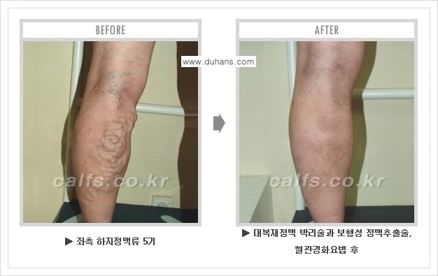 [두한성형외과 경쟁력 정맥류 치료] - [하지정맥류 사진 자료 안내 1.] 관련 이미지 10