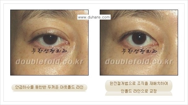 [두한성형외과 경쟁력 쌍꺼풀(눈) 재수술] - [심한 아웃폴드 라인을 인폴드 라인으로의 교정 안내] 관련 이미지 6