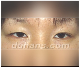 Candidates for Double Eyelid Revision Surgery: Unattractive Double Eyelids, Beautiful Double Eyelids image 10