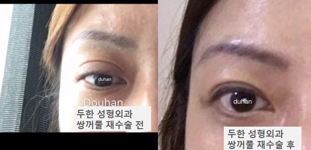 Duhan Plastic Surgery Revision Double Eyelid Surgery image 2
