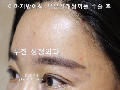 [Duhan Plastic Surgery Eye Surgery] - [Quick Double Eyelid Surgery] image 27