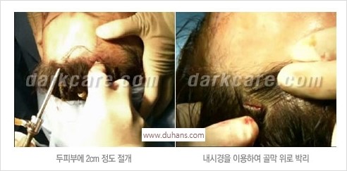 [두한성형외과 경쟁력 주름성형] - [주름제거와 볼륨을 갖게하는 엔도타인 리프팅] 관련 이미지 20