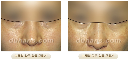 [Duhan Plastic Surgery Wrinkle Removal] - [Wrinkle Removal Treatment Methods] image 6