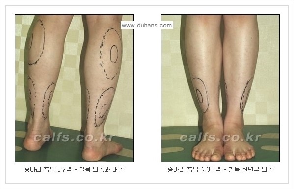 [두한성형외과 경쟁력 멀티종아리성형] - [나에게 맞는 종아리 시술 방법과 종류 안내 ②] 관련 이미지 3