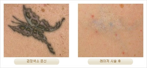 [두한성형외과 경쟁력 안전성형] - [최첨단 장비를 이용한 흉터, 점, 주근깨, 잡티, 문신제거 레이저 시술] 관련 이미지 35